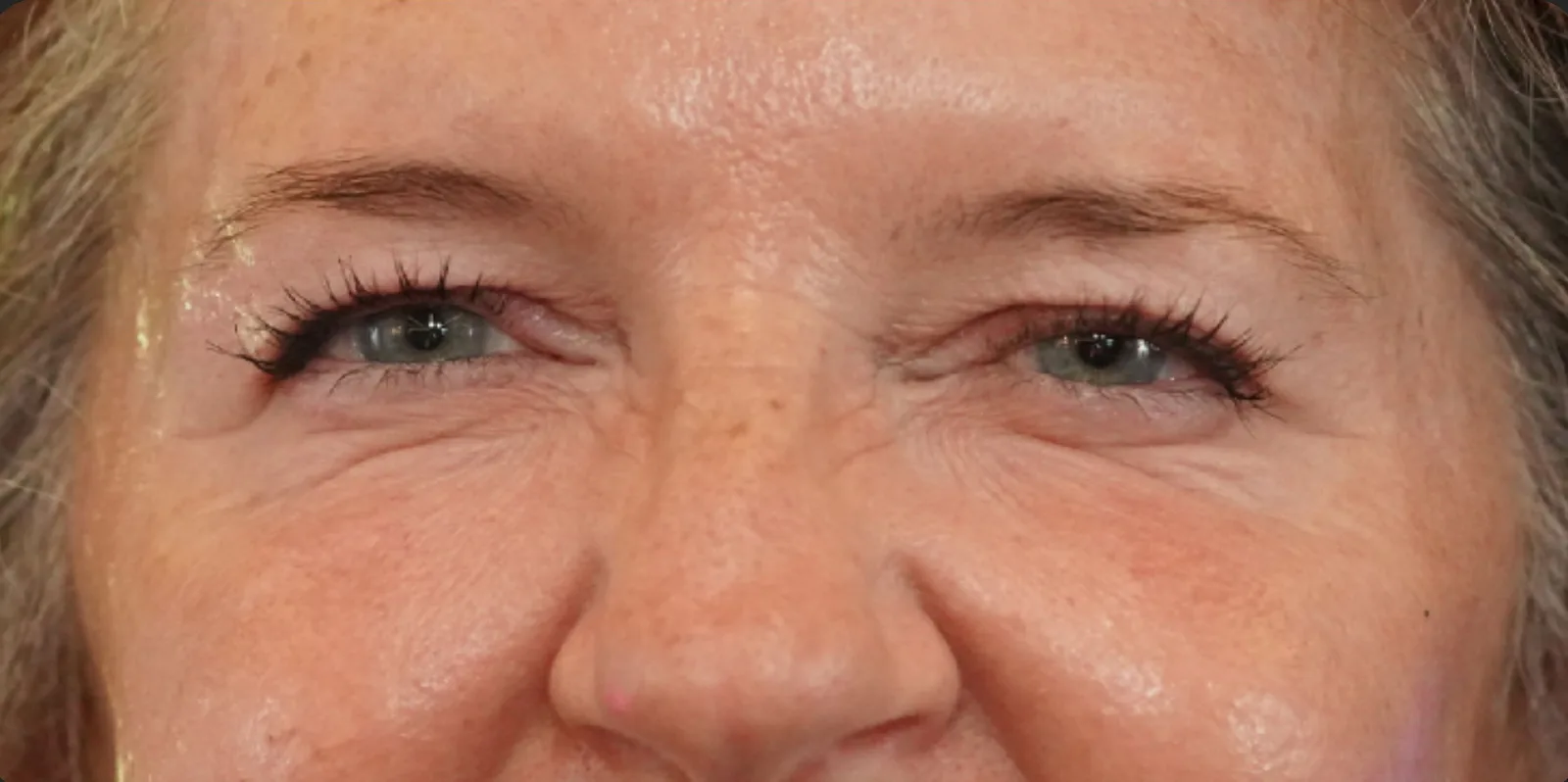 Crow’s feet after treatment at Trandi Med Spa