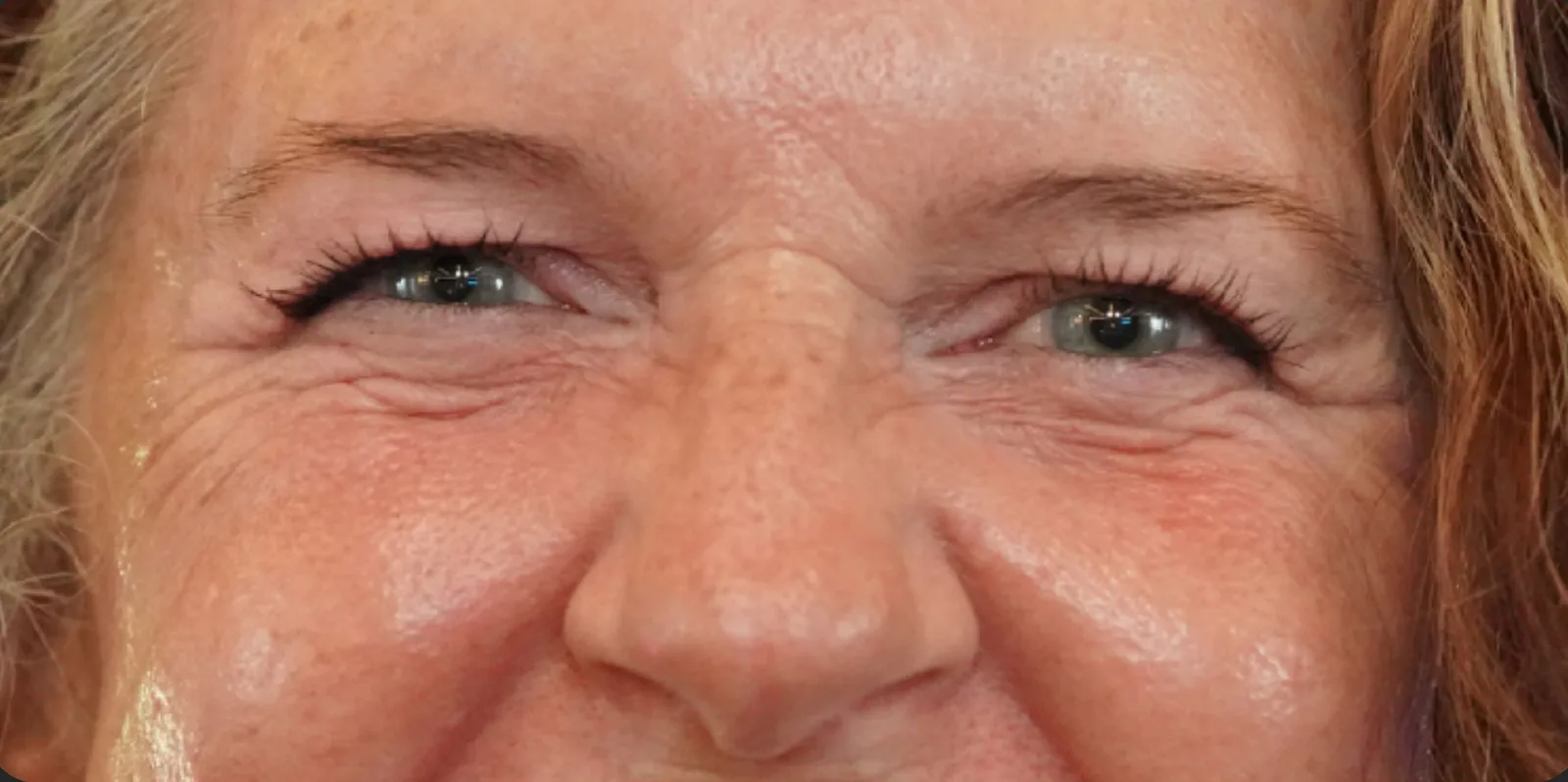 Crow’s feet before treatment at Trandi Med Spa
