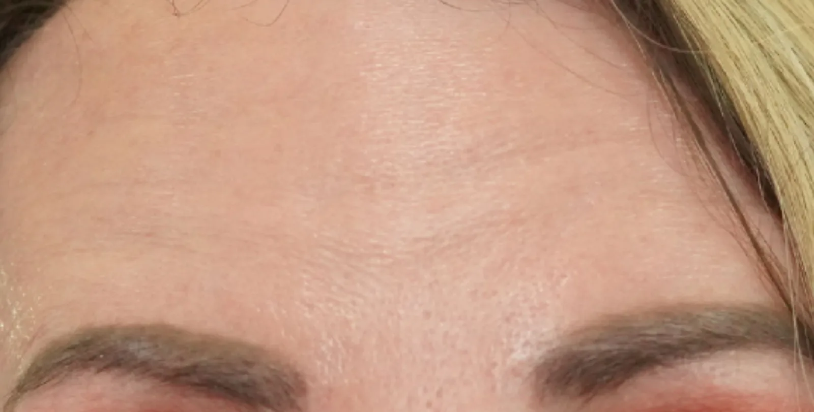 Forehead after treatment at Trandi Med Spa