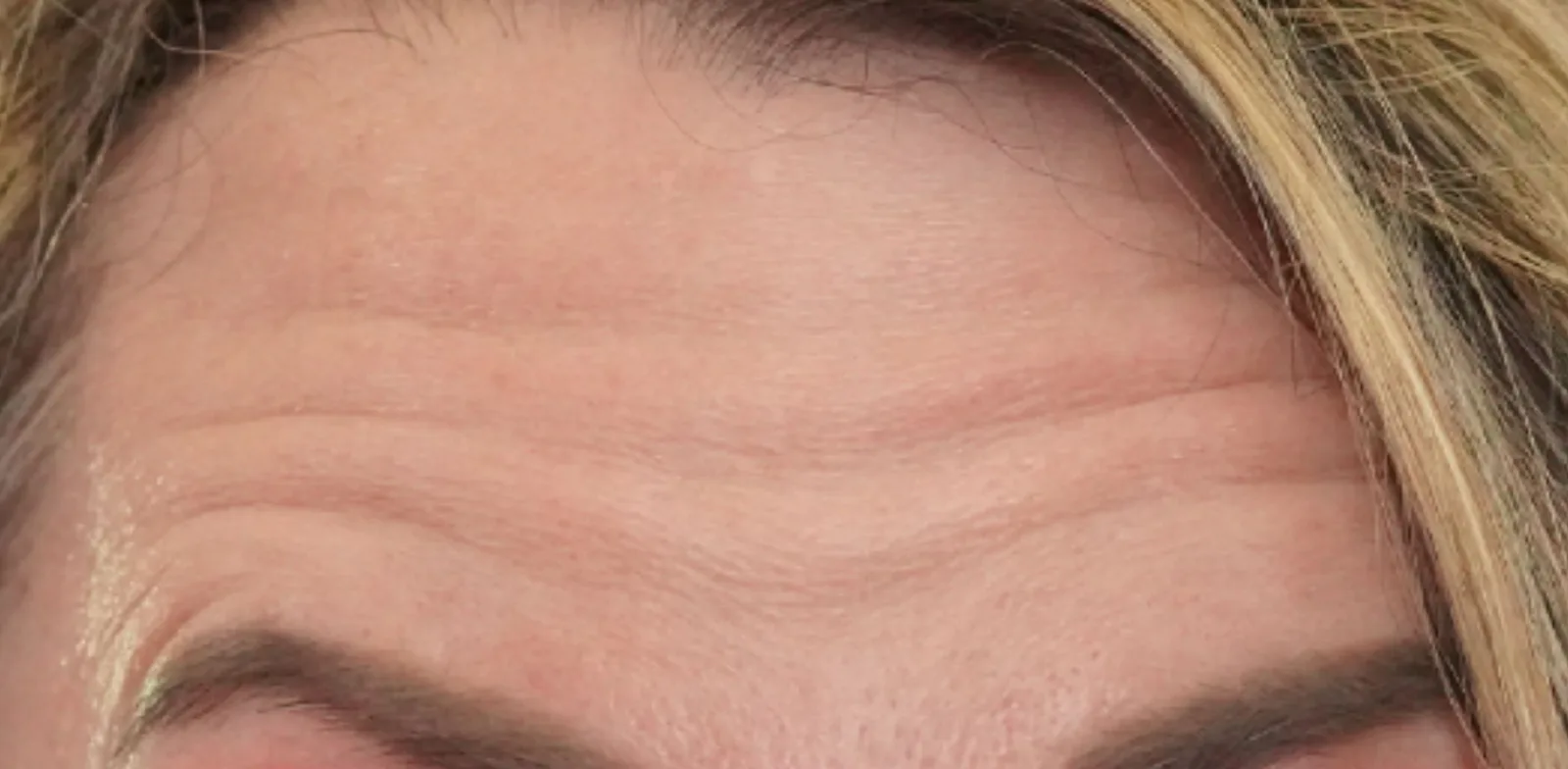 Forehead lines before treatment at Trandi Med Spa