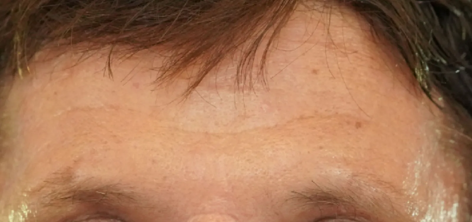 Forehead and frown lines after treatment at Trandi Med Spa