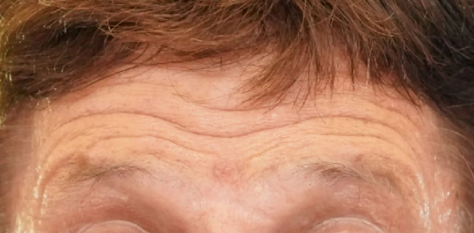 Forehead and frown lines before treatment at Trandi Med Spa