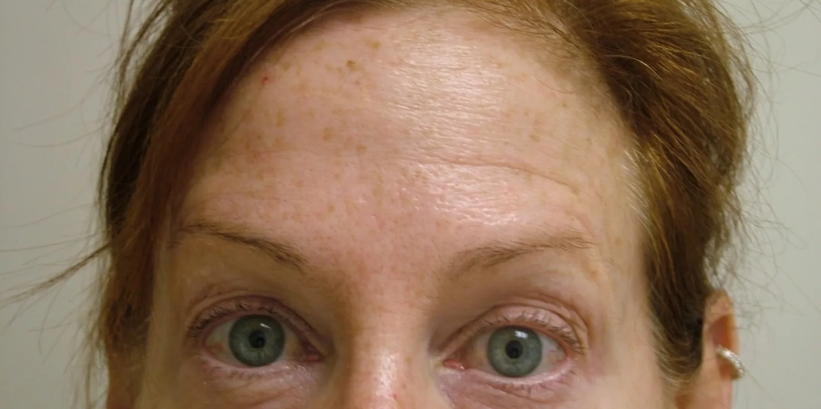 Forehead after treatment at Trandi Med Spa