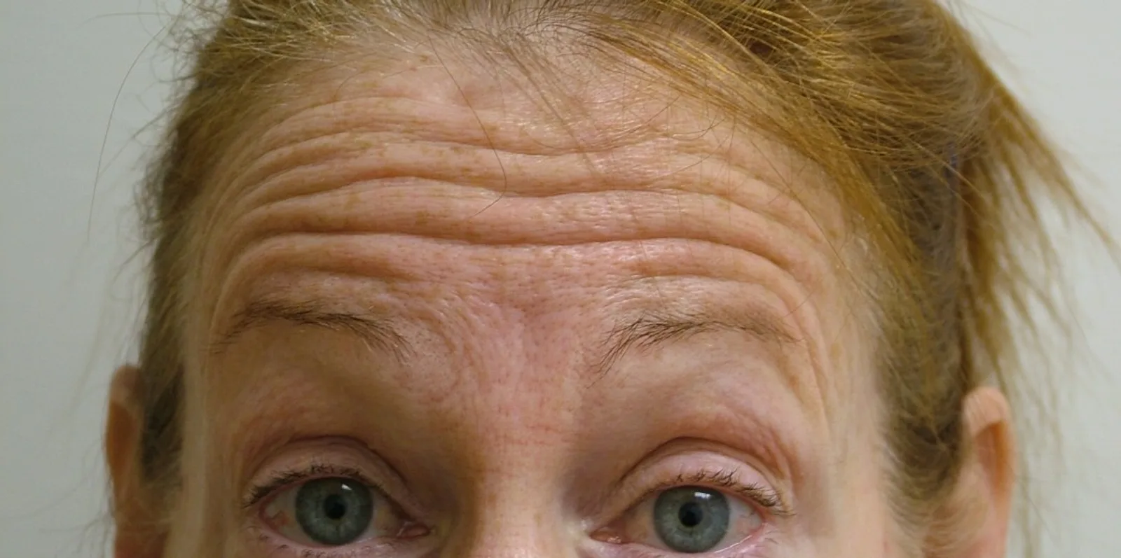 Forehead lines before treatment at Trandi Med Spa