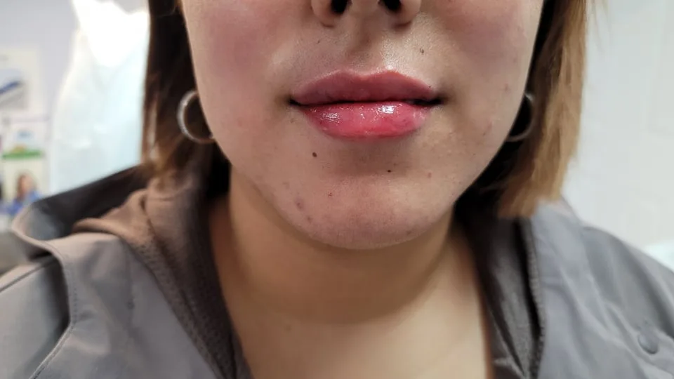 Lips after treatment at Trandi Med Spa