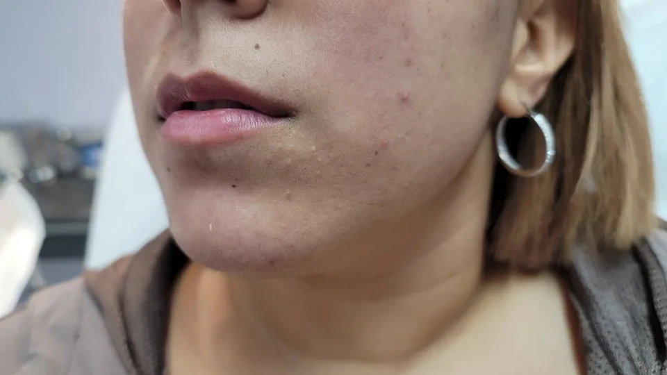 Lips before treatment at Trandi Med Spa